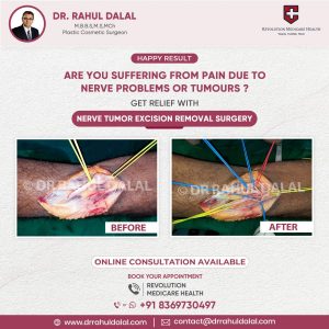 nerve-tumor-excision-removal-scaled