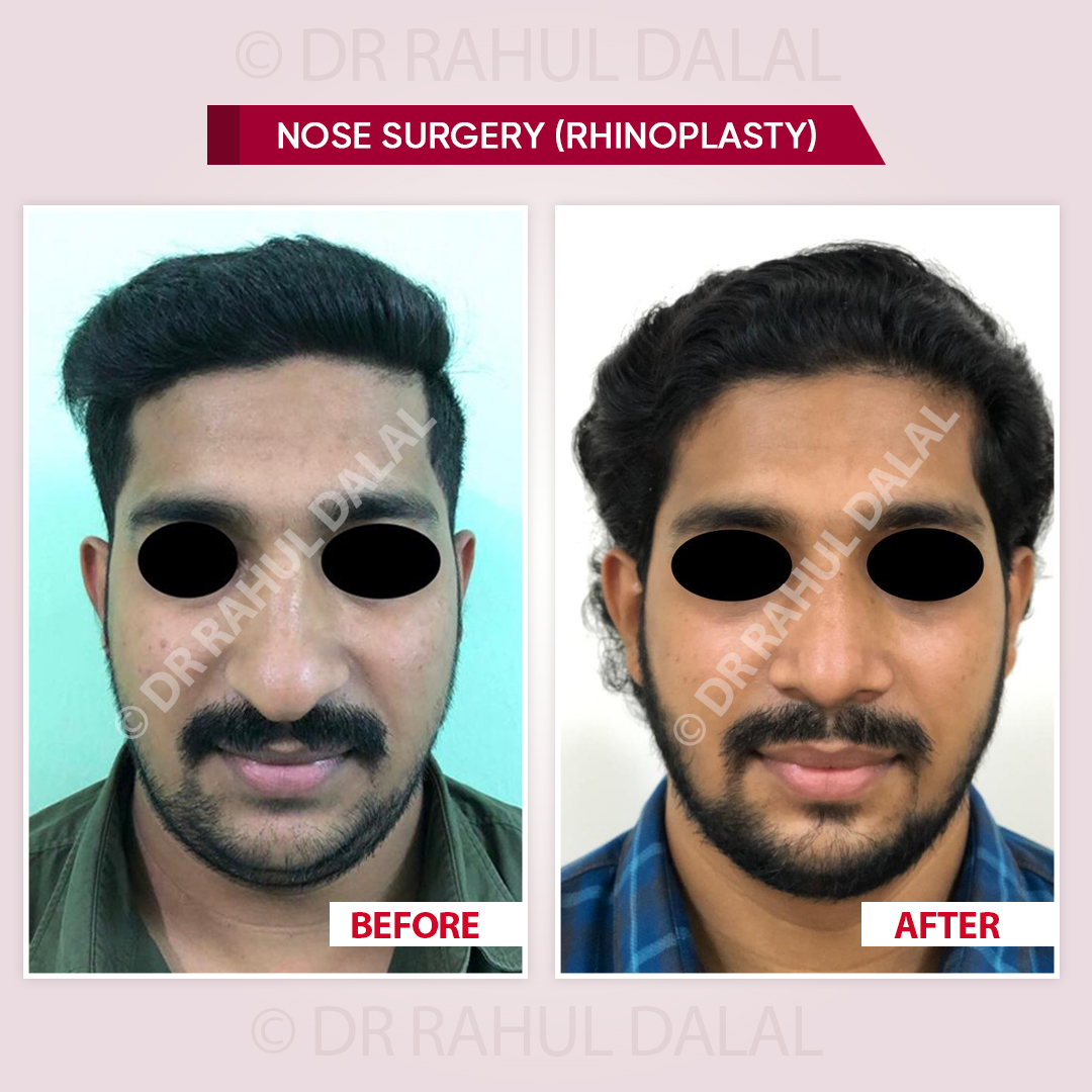 Nose surgery - Dr. Rahul Dalal