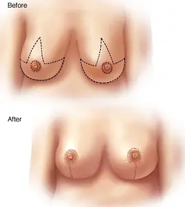 Dr. Rahul Dalal, breast reduction surgeon in Pune.